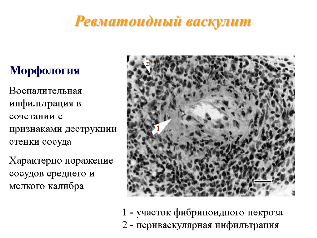 Ревматоидный васкулит 1 2 Морфология Воспалительная инфильтрация в сочетании с признаками деструкции стенки сосуда